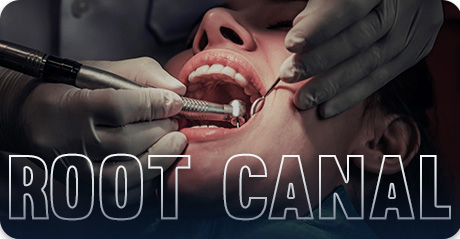 How much are root canals? Dental tourism