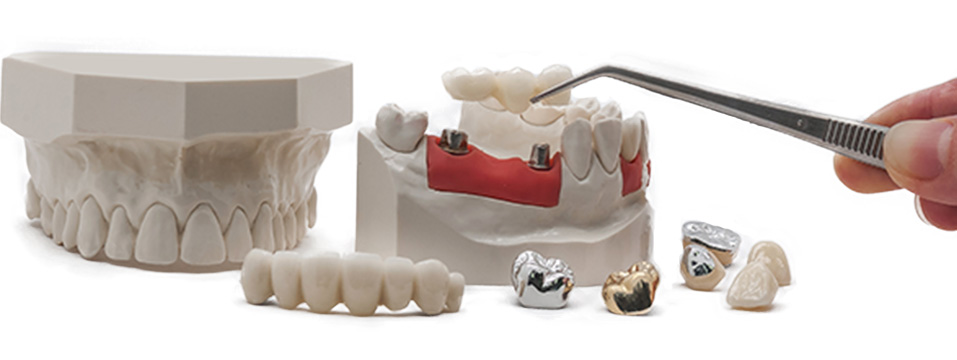 Dental bridges