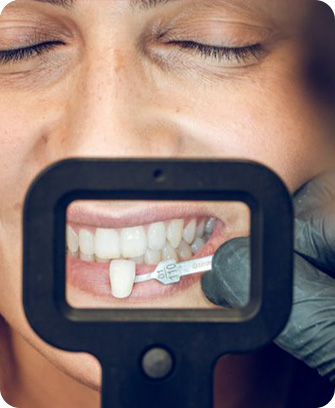 Teeth evaluation and smile design - Process of getting veneers
