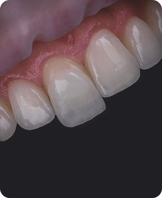 Cementation veneers - Process of getting veneers