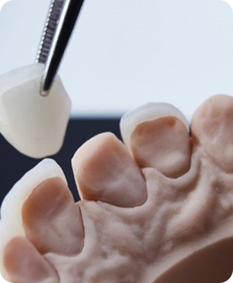 Dental lab - Process of getting veneers