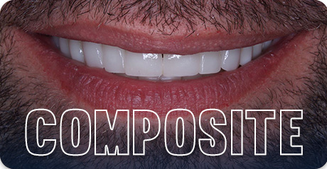 Real patient dental tourism - Composite veneers