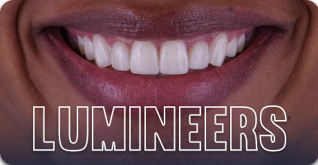 Real patient dental tourism - Lumineers