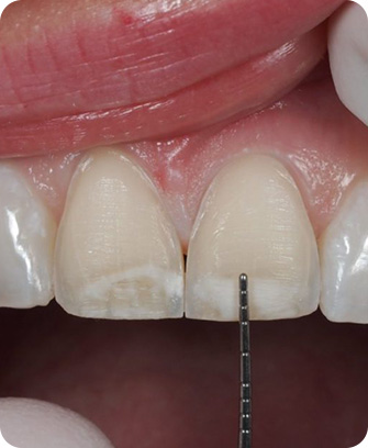 Teeth preparation - Process of getting veneers