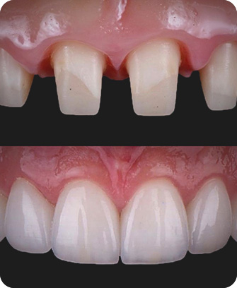 Before and after dental crowns in Mexico