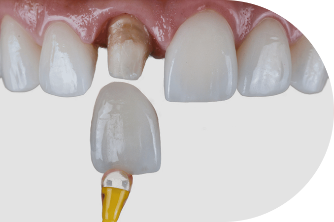Dental crowns - before-after - tooth preparation