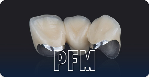 Types of crowns - Porcelain fused to metal crowns