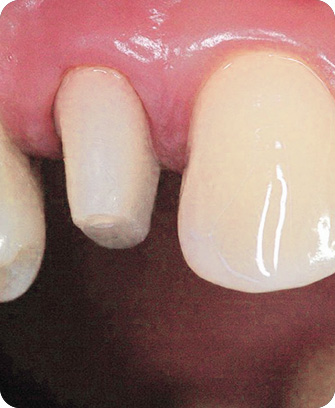 Tooth shaving dental crowns process - Step 2