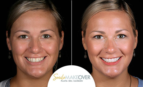 Real Patient, before after - Smile Makeover Playa del Carmen