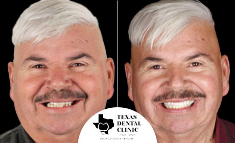 Real Patient, before after - Texas Dental Clinic