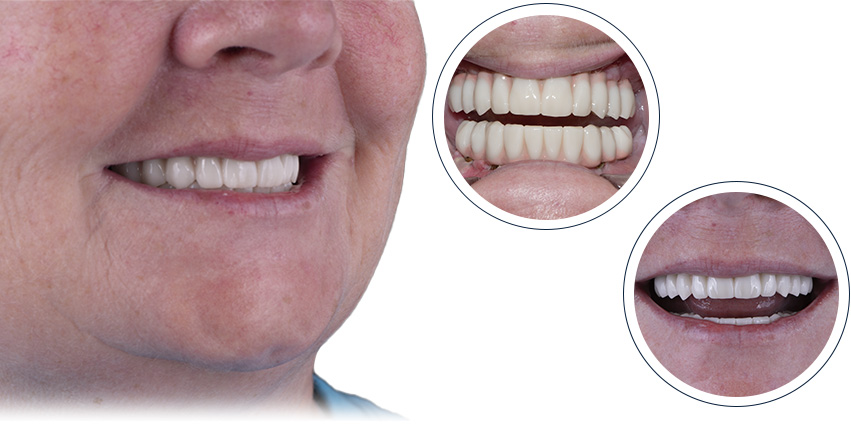 Before after Full Mouth Dental Implants