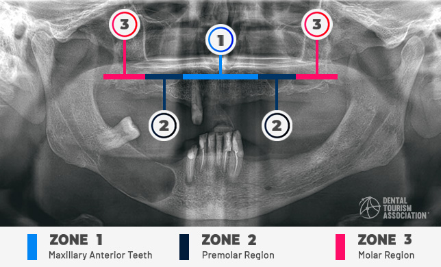 Bedrossian's classification - Oral zones Infographics