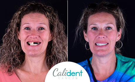 Real Patient, before after - Calident Cancun