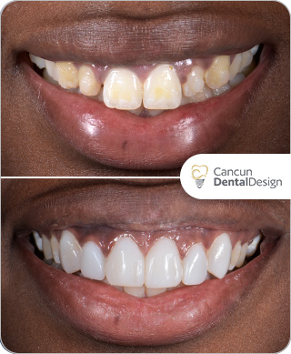 Before after smile makeover Cancun Dental Design