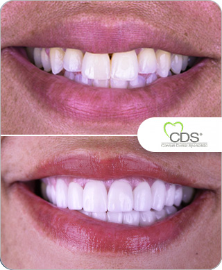 Before after smile makeover Cancun Dental Specialists