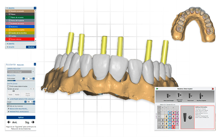 Digital Design, Implant planning