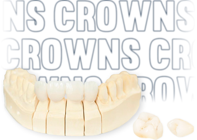 Benefits of getting crowns