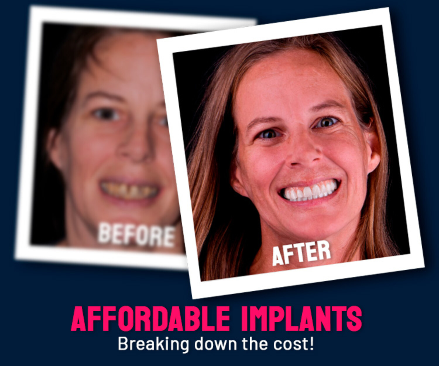 Affordable Dental implants abroad, real patient case