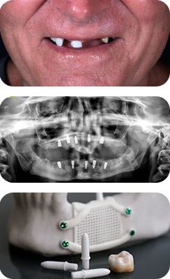 Factors affecting the number of dental implants