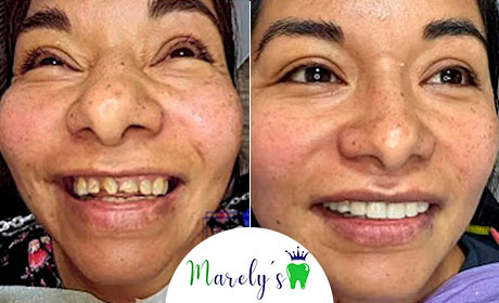 Dr. Luz Marely, real patient before after