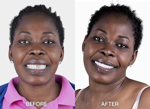 Esthetic Dentistry Before and AFter