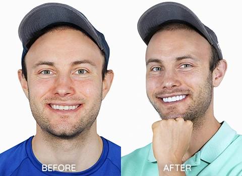 Esthetic Dentistry Before and AFter