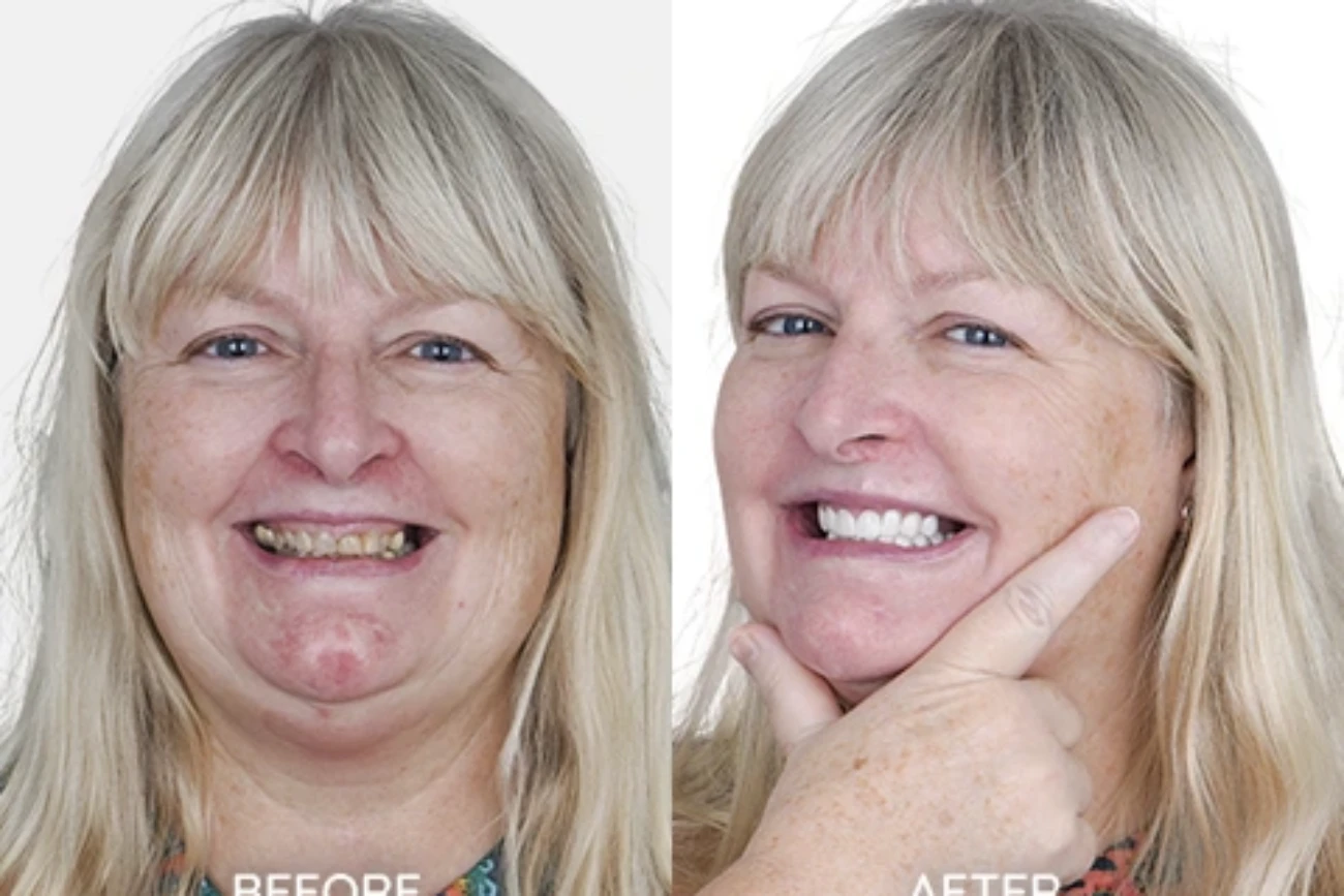 Esthetic Dentistry Before and AFter