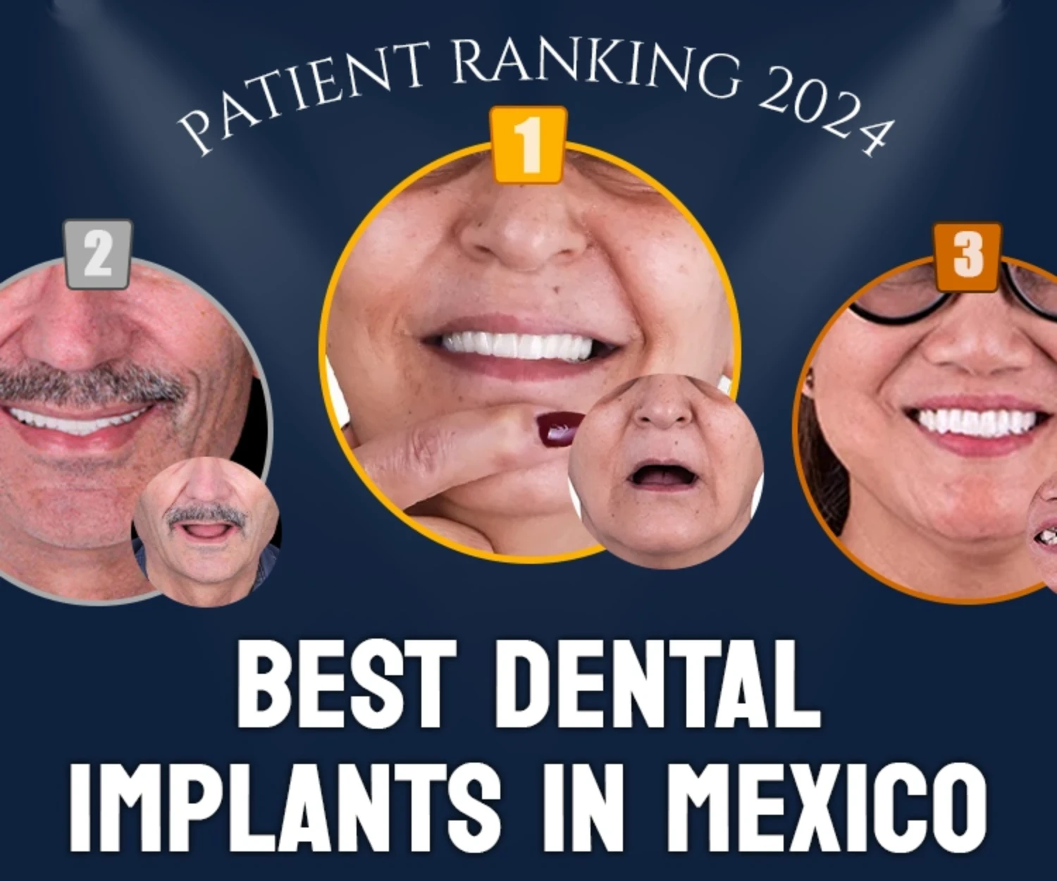 Best Dental Implants in Mexico