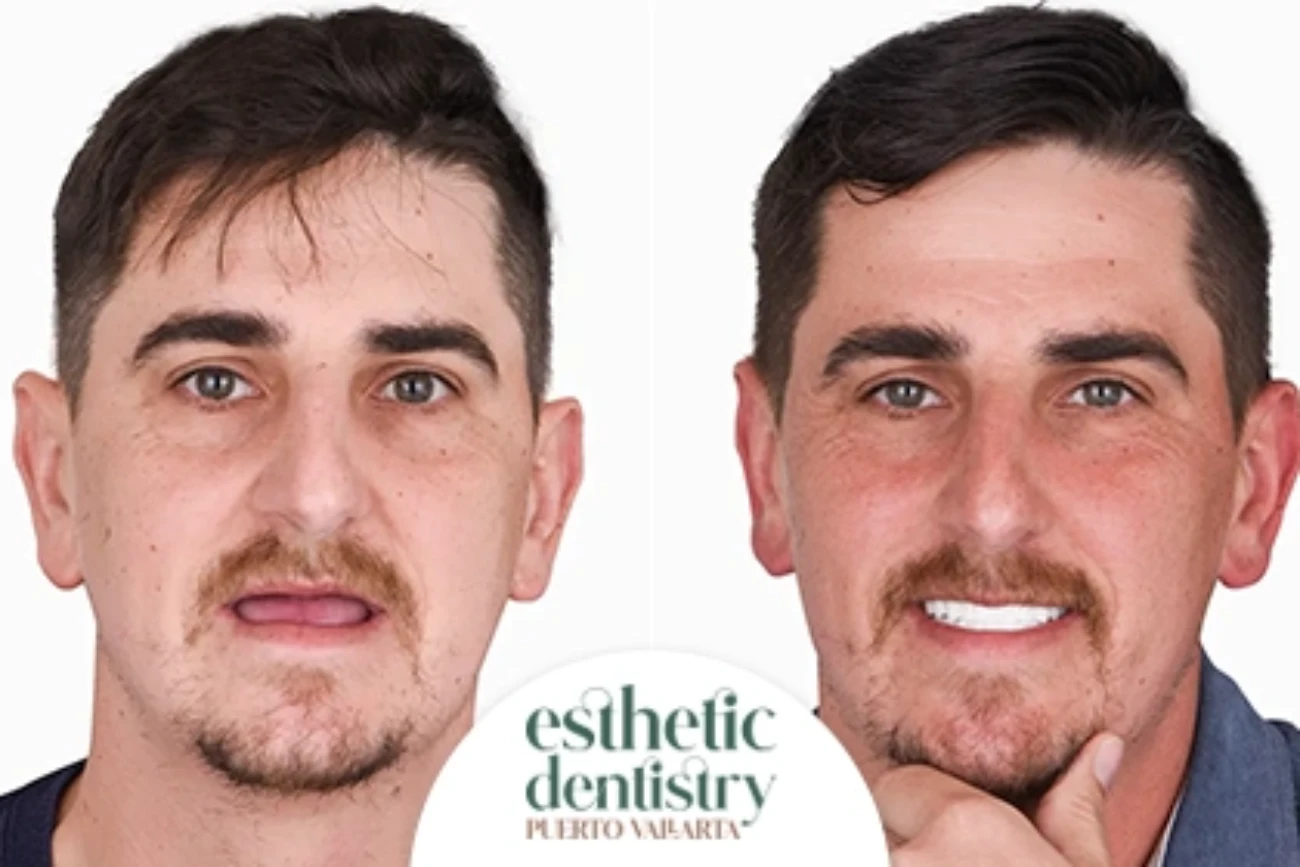 Best Dental implants in Puerto Vallarta