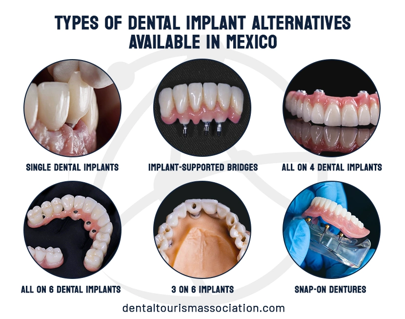 Types of dental implants in Mexico