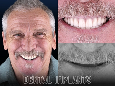 Patient Dental Implants – Smile Crafters, Algodones