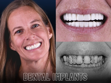 Patient Full Mouth Dental Implants – Cancun Dental Specialists, Cancun