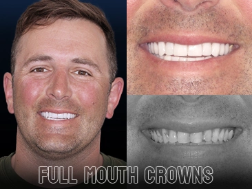 Patient Dental Crowns – Paradise Dental, Los Cabos