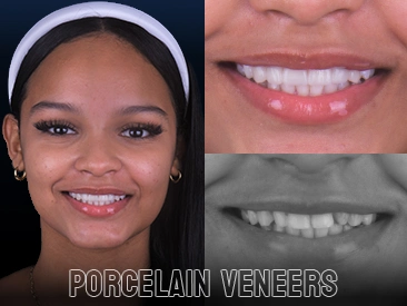 Patient Porcelain Veneers – A1 Smile Design, Playa del Carmen