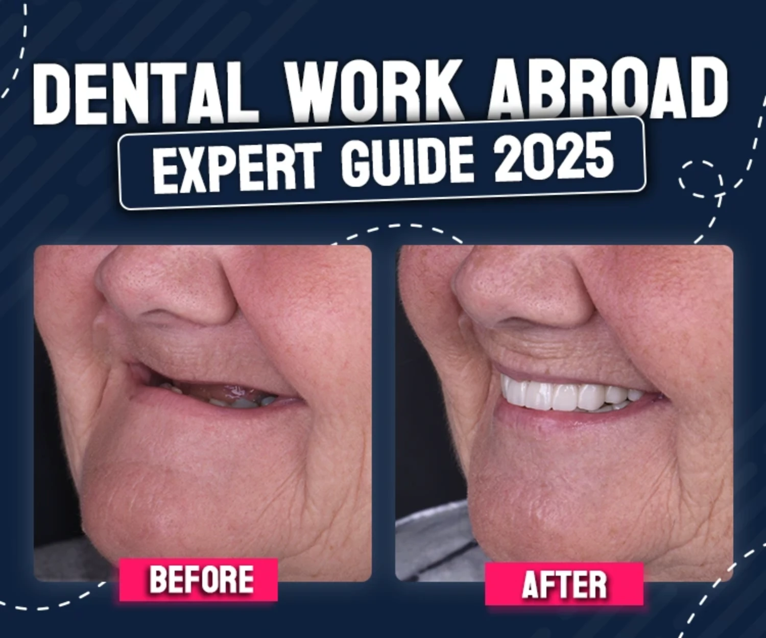 Before after dental Implants abroad, featured image