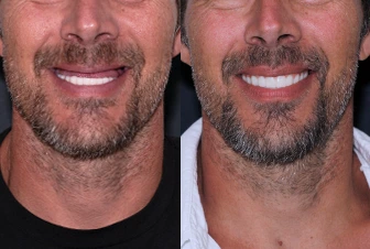 Dental work on a patient in San Miguel de Allende, before and after
