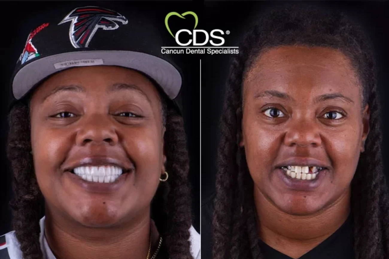 Top dentist for Dental Implants in Mexico. Dental clinic in Cancun for dental tourism.