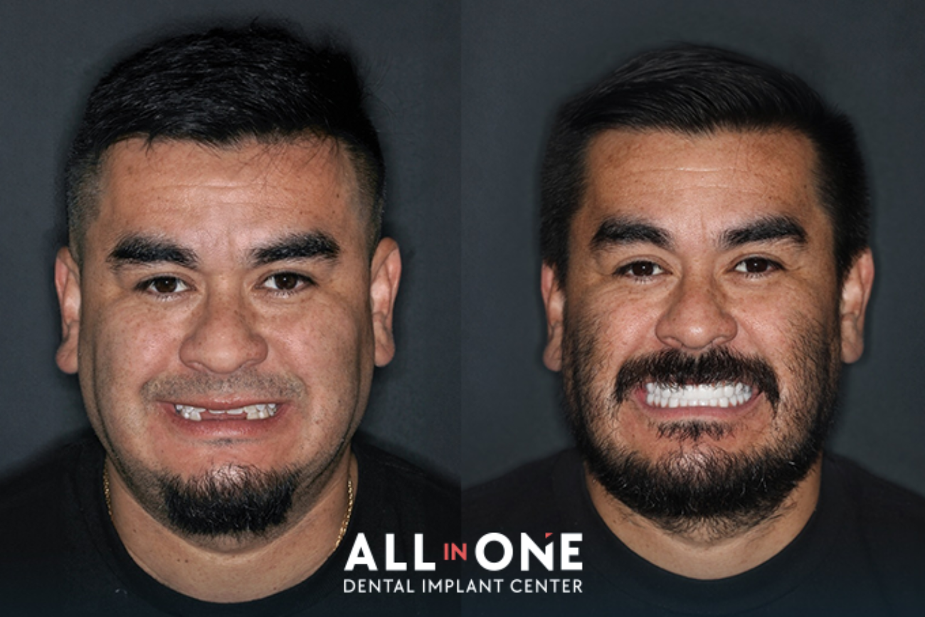 Leading All in One Tijuana clinic for Dental Implants in Mexico and dental tourism.