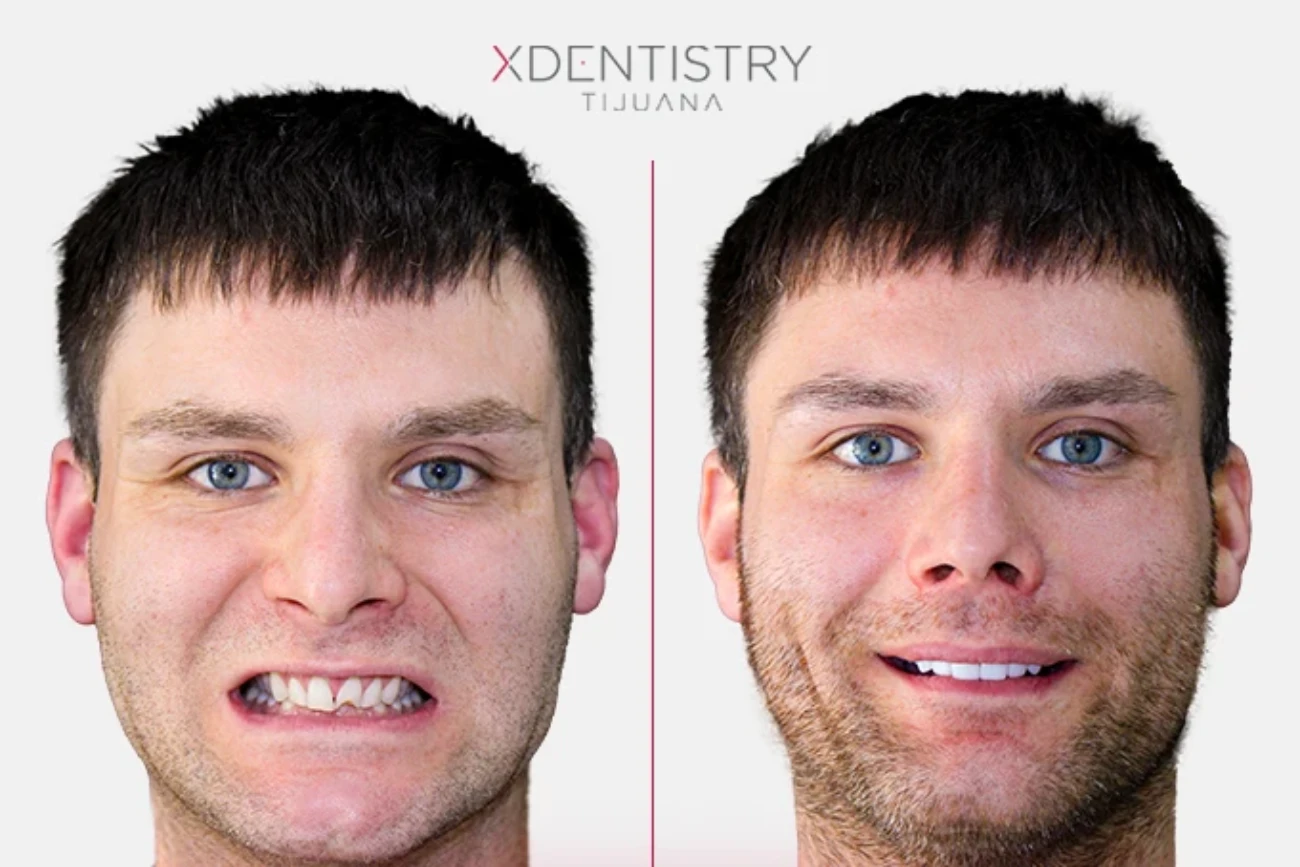 Dental tourism provider for Dental Implants in Mexico, XDentistry Tijuana.