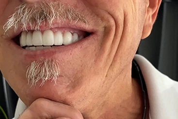 Timeline for final restoration of Dental Implants in Mexico.