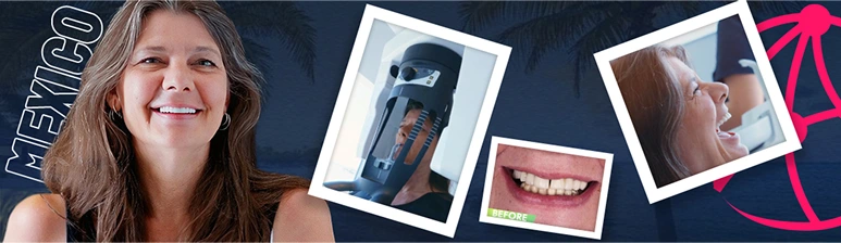 What to expect during a complete Dental Tourism experience with Dental Implants in Mexico.