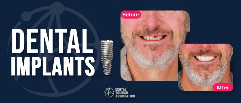 Before and after dental implants smile comparison of male patient in Mexico