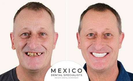All-on-4 real patient, before and after dental work at Mexico Dental Specialists